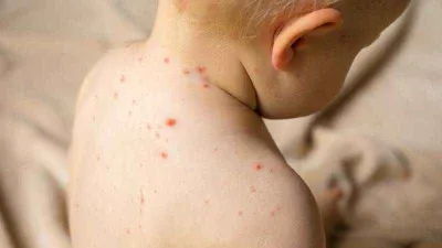  Aşı karşıtlığı kızamık vakalarını artırdı