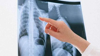 Bu kanser türü erkeklerde daha çok görülüyor