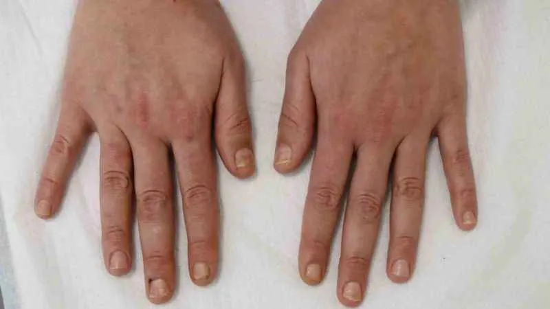 Soğuk havalar deri hastalıklarını da tetikliyor