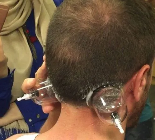 Hacamat kulak arkasına yapılır mı? Faydaları nelerdir