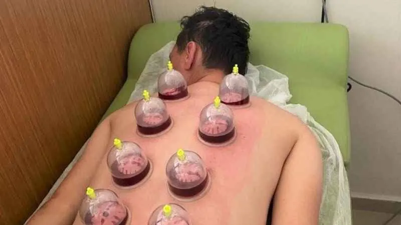  Devlet hastanesinde hacamat ve akupunktur tedavisi