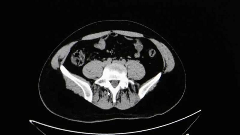 Sıcaklarda idrar yolu enfeksiyonuna dikkat