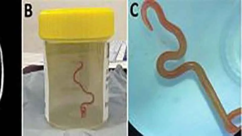 Dünyada ilk: Avustralya'da bir hastanın beyninden canlı solucan çıkarıldı