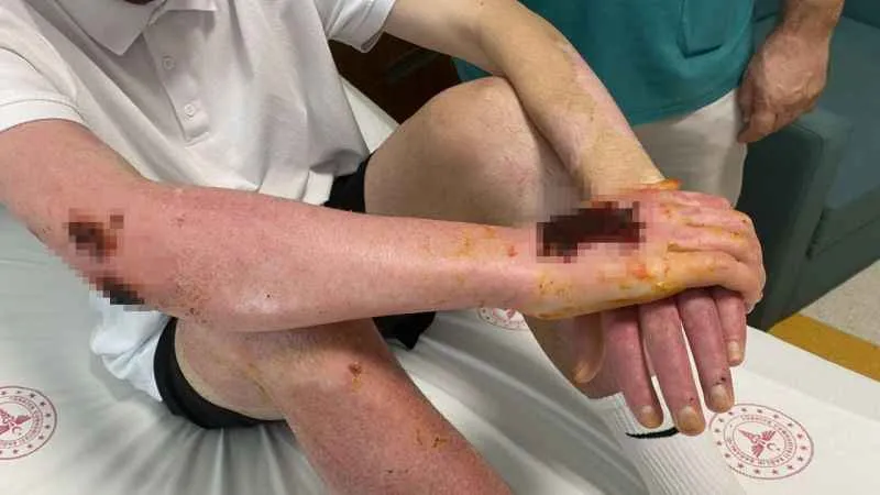 Deodorant sıkılırken çakılan çakmak sonları oluyordu