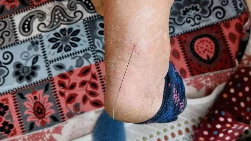 Ayak topuğundan çıkan tel şaşırttı!
