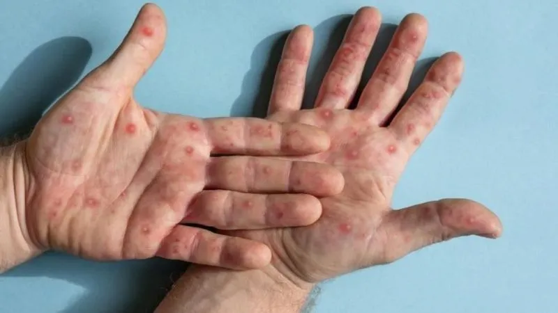 İstanbul İl Sağlık Müdürlüğü’nden "İstanbul’da maymun çiçeği görüldü" iddialarına ilişkin açıklama