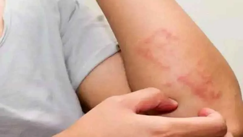 Besin alerjisi mi besin intoleransı mı?