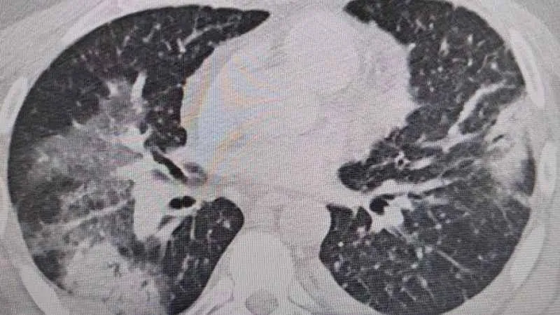 Klimalar yaz zatürresine neden olabilir
