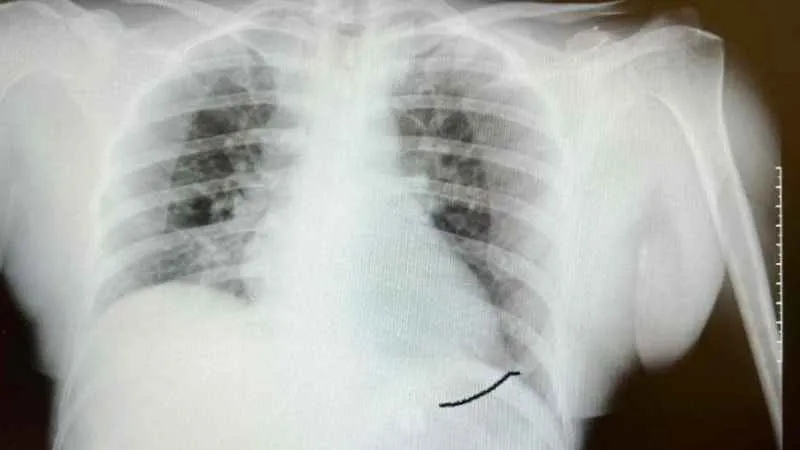 Tıp literatüründe ender görülen olay