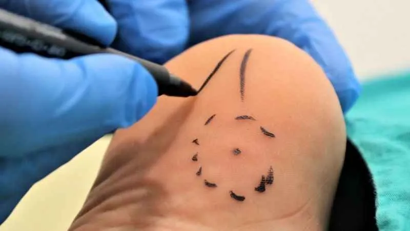 Topuk dikenine dakikalar içerisinde çözüm