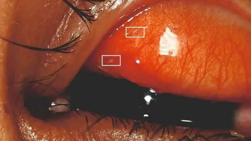 Gözünden sinek larvaları çıktı