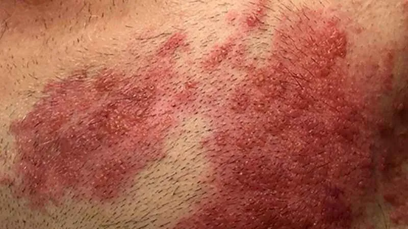 Korona sonrası viral hastalıklar coştu