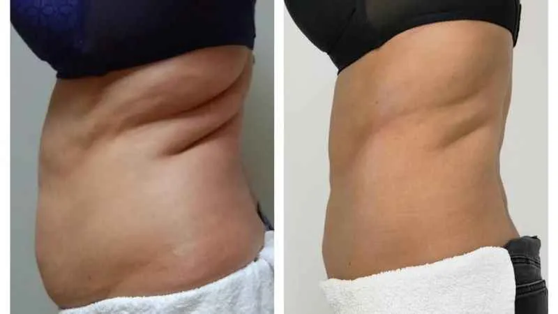 Tek seansta 3.5 santim incelme mümkün