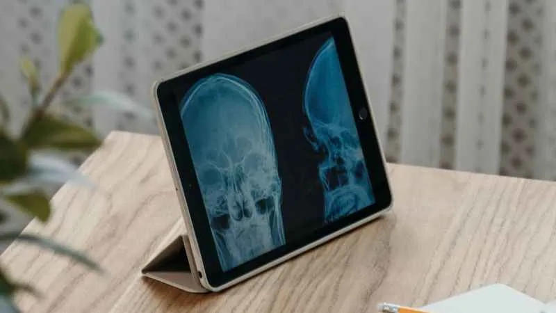 Beyin tümörleri, kan testiyle erken teşhis edilebilecek!