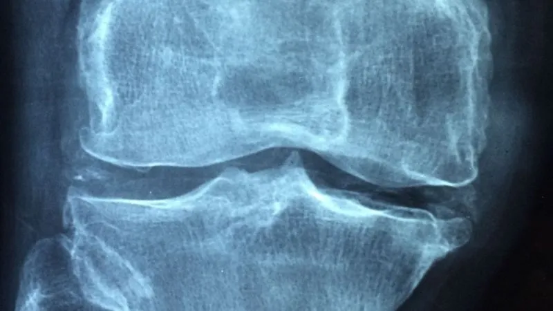 Kemik kırıkları kök hücre ile iyileştiriliyor