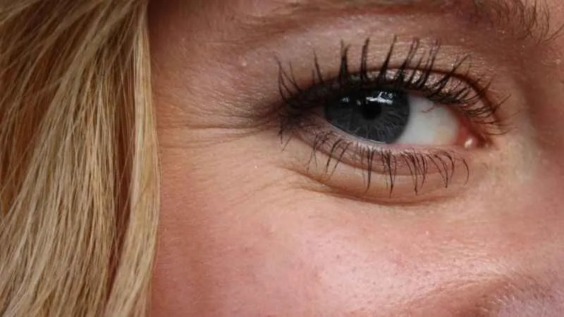 Van'da göz kapağına estetik!