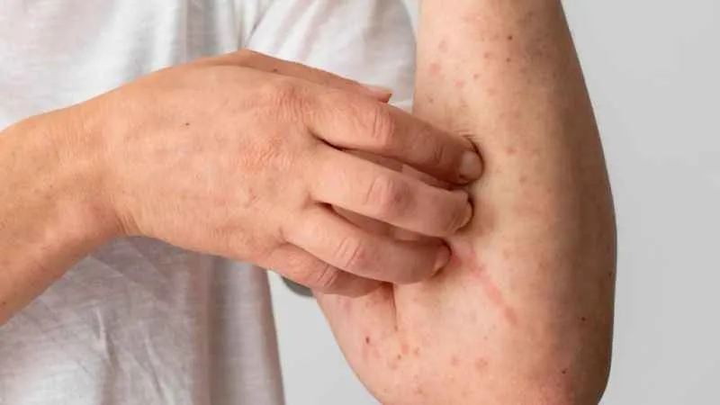 Küresel kızamık tehlikesi yükseliyor: DSÖ Çağrı yaptı