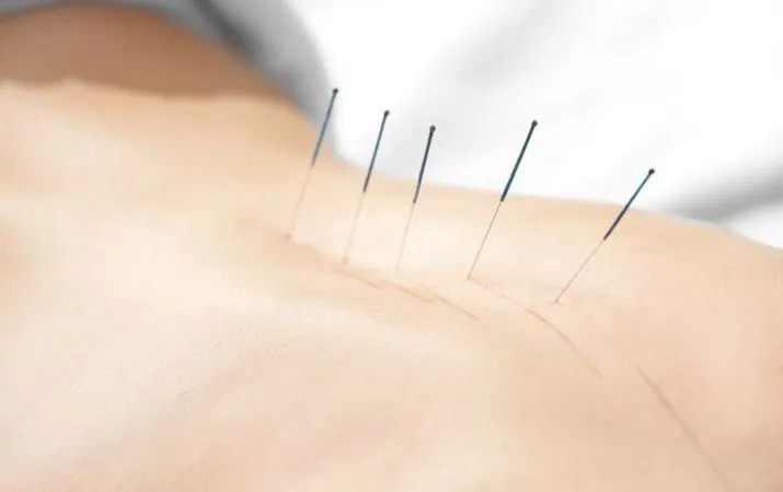 Oruçlu Kimse Akupunktur Yaptırabilir Mi?